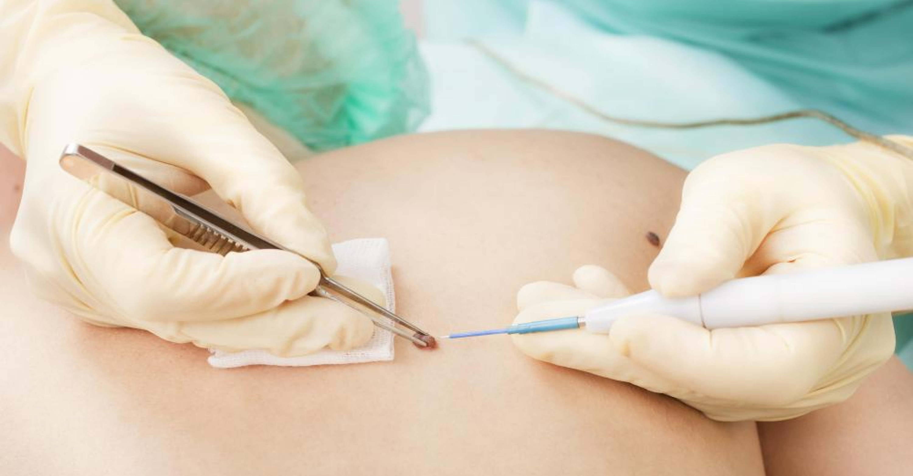 Skin Tags Medical Guide Should You Get Surgery? Skintify